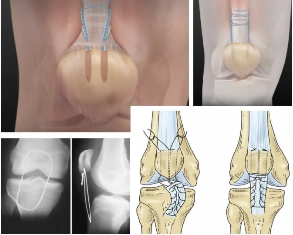 Ρήξη τένοντα τετρακεφάλου